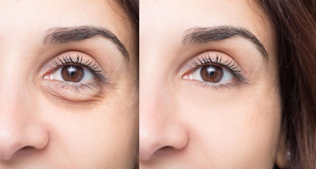 Professional-Tips-to-Reduce-Dark-Circles