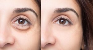 Professional-Tips-to-Reduce-Dark-Circles