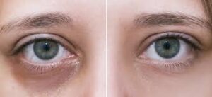 Professional-Tips-to-Reduce-Dark-Circles